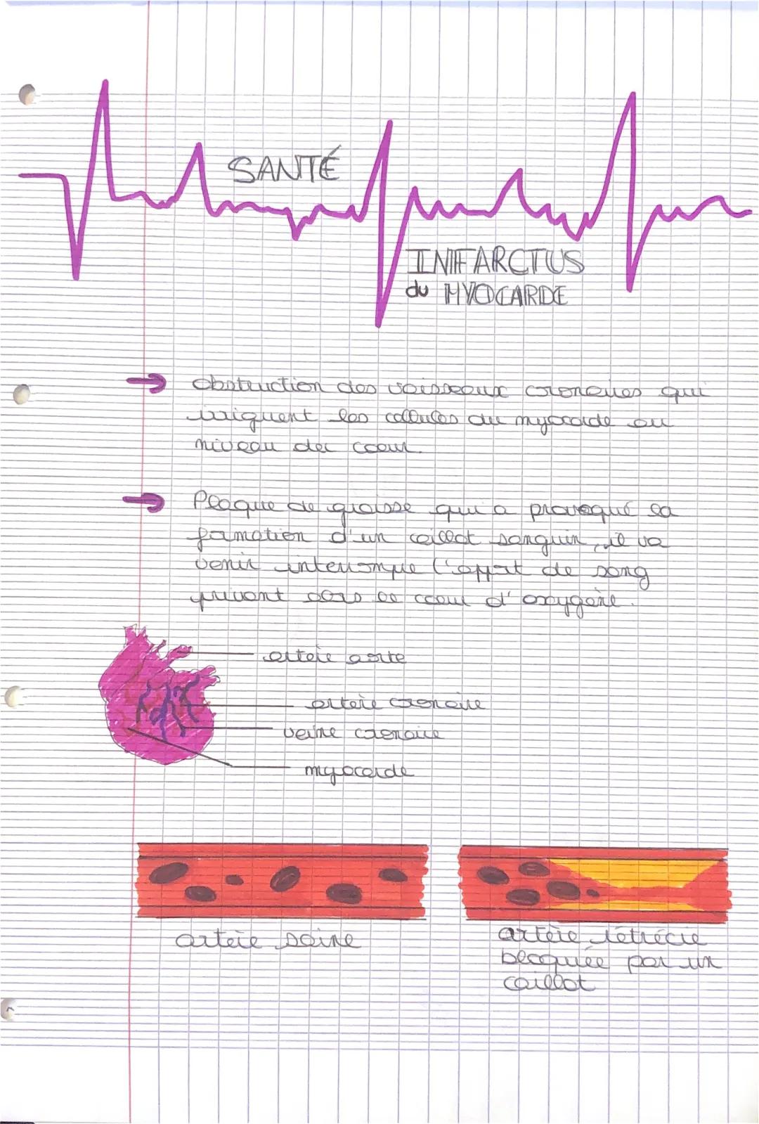 Comprendre les causes de l'infarctus du myocarde et les symptômes de l'hypertension artérielle