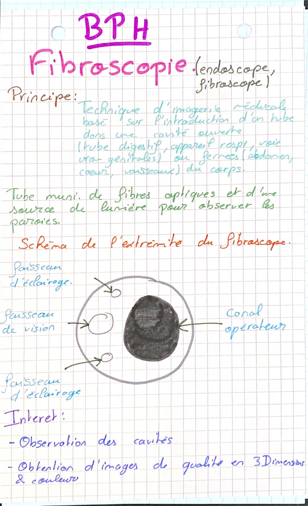 BPH
Fibroscopie fendoscope
Principe:
Tube muni. de fibres optiques et d'une
de lumière pour observer les
source
paroies.
Schema de l'extrémi