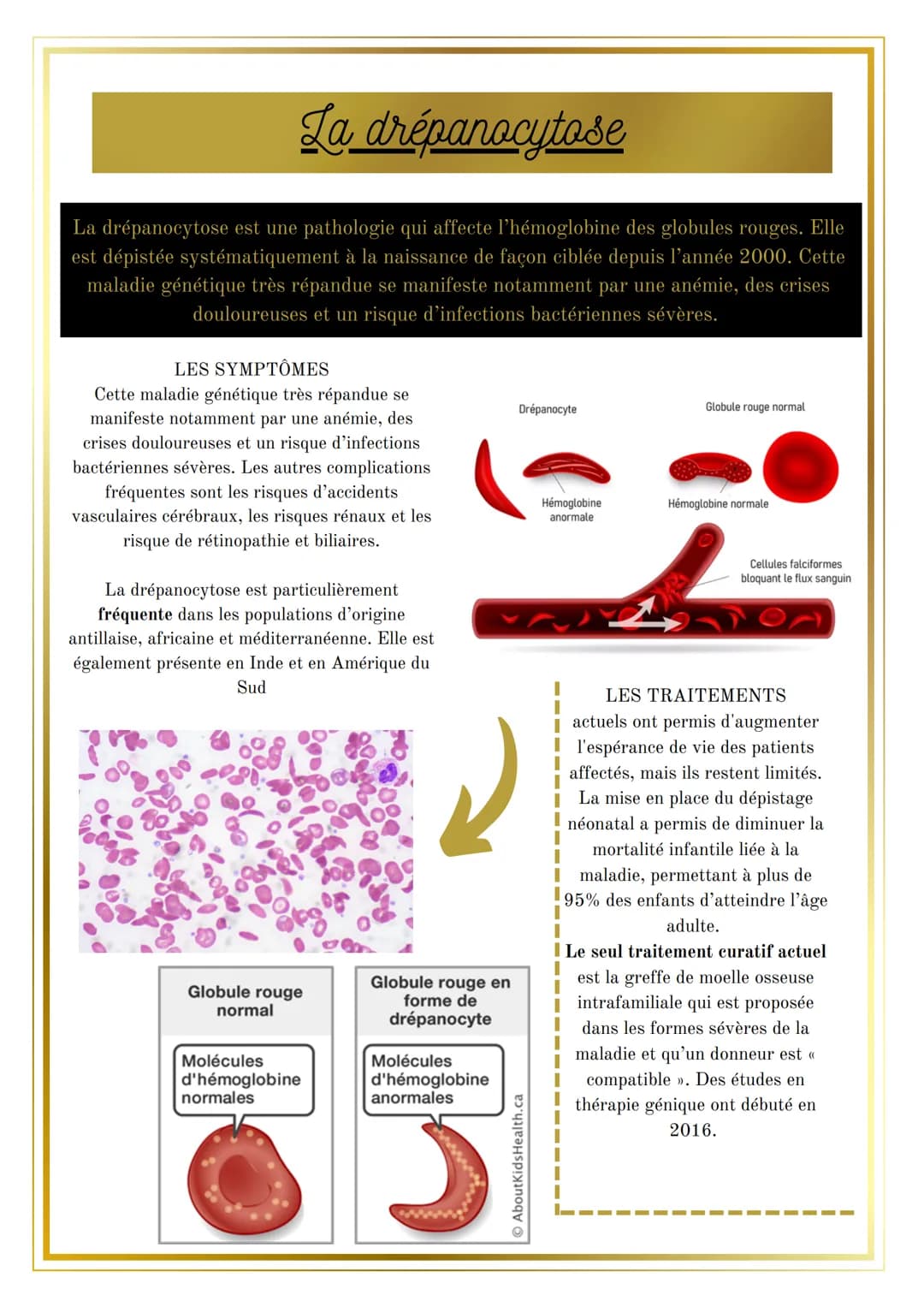 La drepanocytose
La drépanocytose est une pathologie qui affecte l'hémoglobine des globules rouges. Elle
est dépistée systématiquement à la 