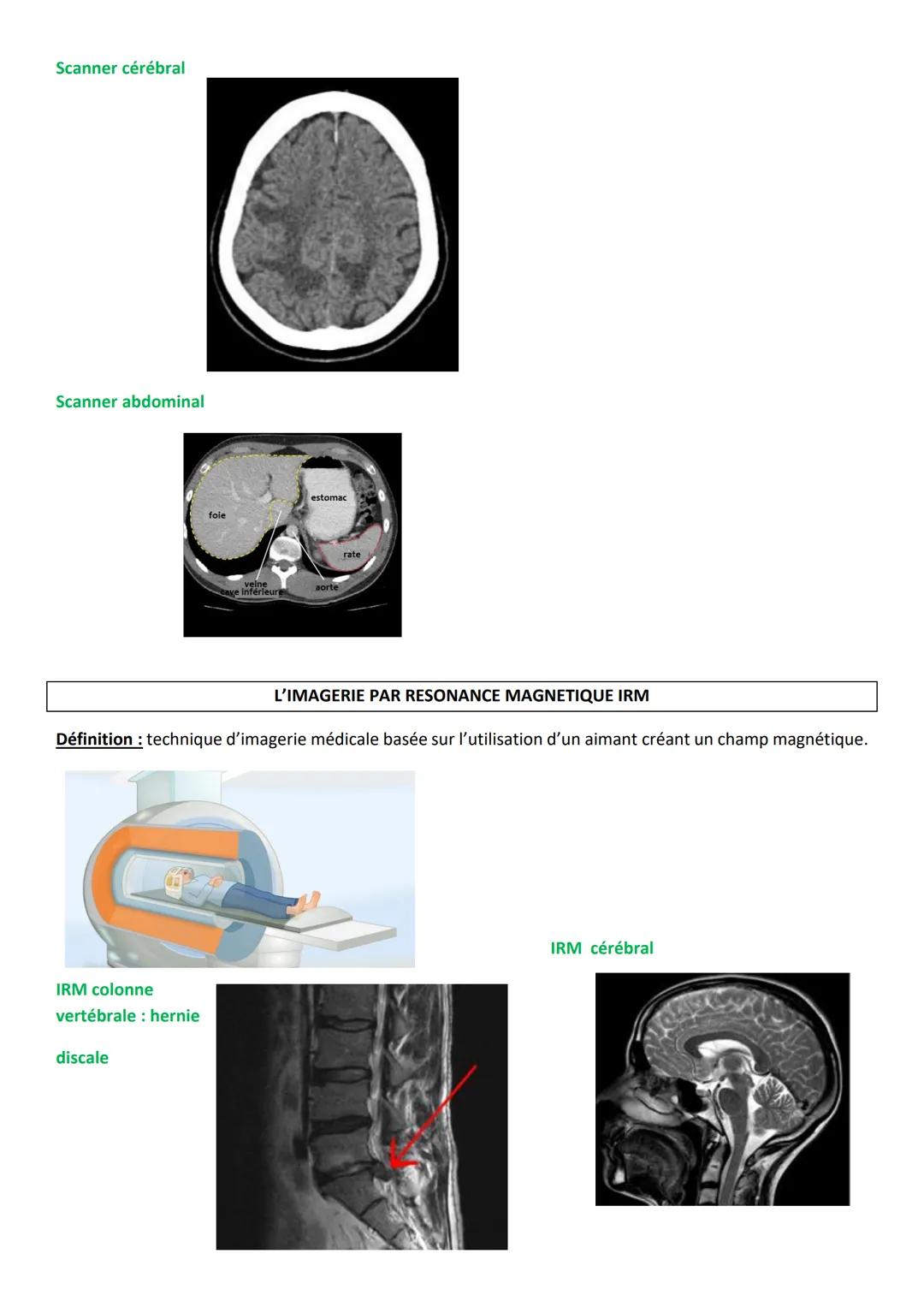 LA TOMODENSITOMETRIE ou SCANNER
Définition technique d'imagerie médicale basée sur l'utilisation des rayons X qui tournent autour du
patient