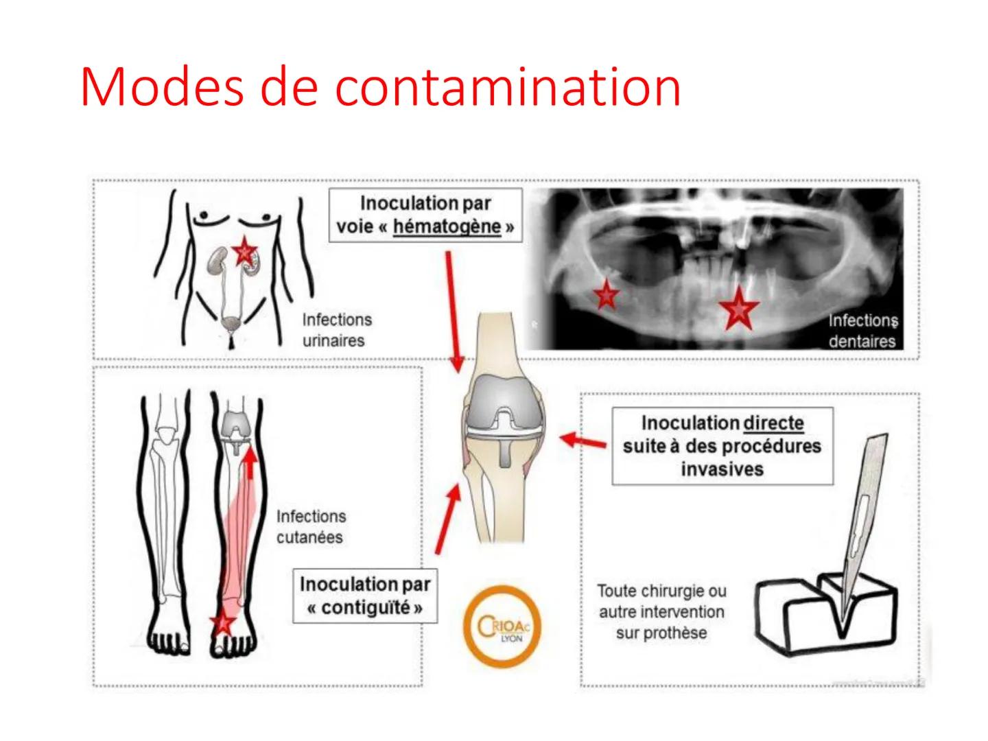 Infections
Ostéoarticulaires
Ostéite et ostéomyélite Définition et épidémiologie
• Une infection ostéo-articulaire est une infection à
bacté